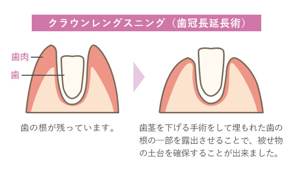 クラウンレングスニング