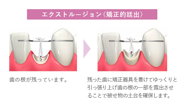 エクストルージョン