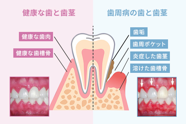 歯周病