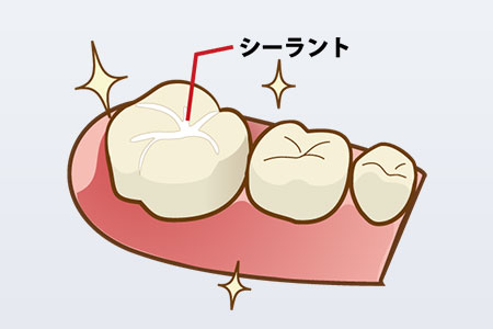 シーラント