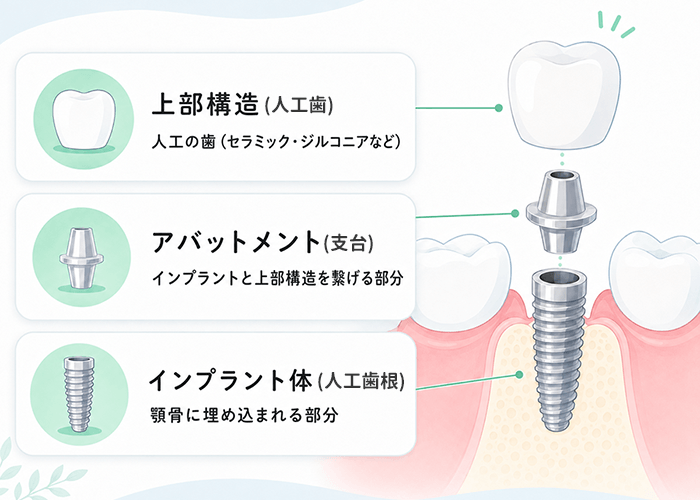 インプラント構造の説明図