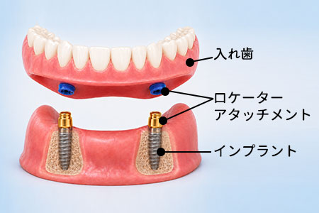 ロケーター義歯