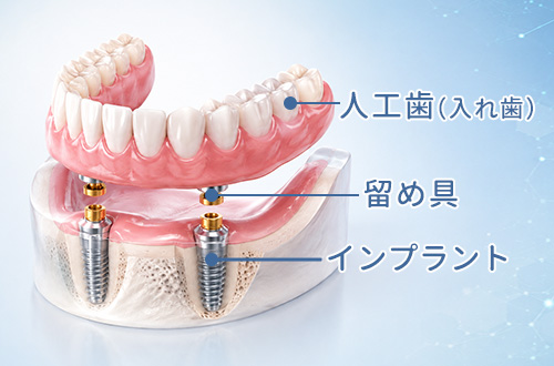 オーバーデンチャー詳細