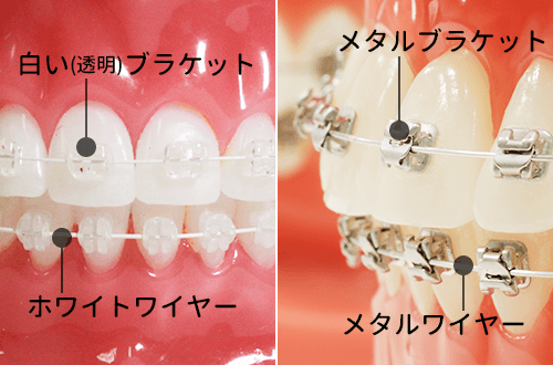 ワイヤーとブラケットの比較