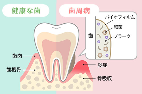 健康な歯ぐきと歯周病の歯ぐきの比較